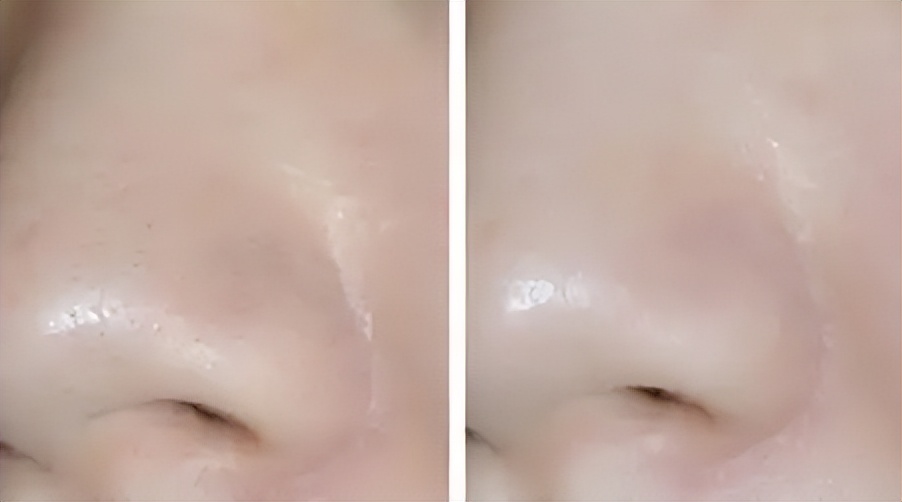 皮秒缩毛孔恢复过程图,去油缩毛孔最好的方法
