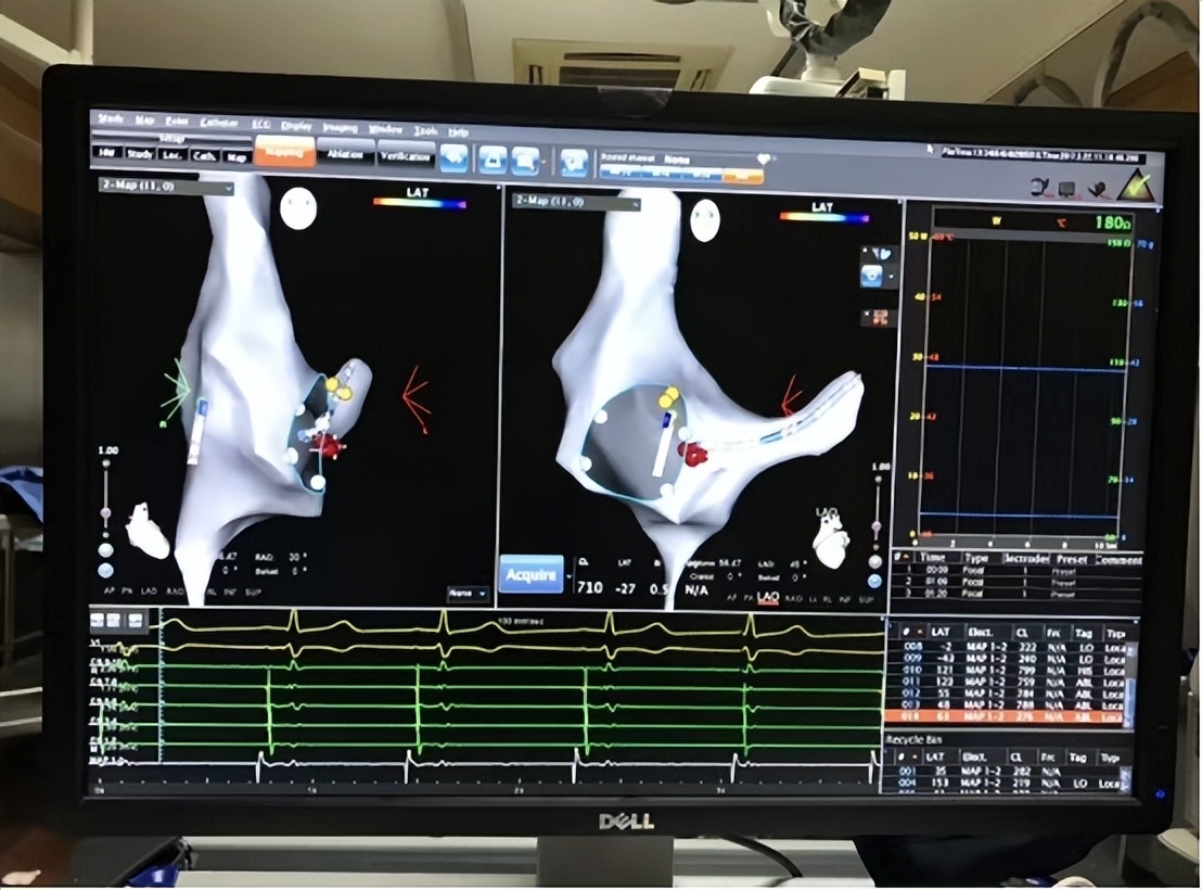 室上速儿童射频消融术最佳年龄,儿童做室上速心脏射频消融哪里好