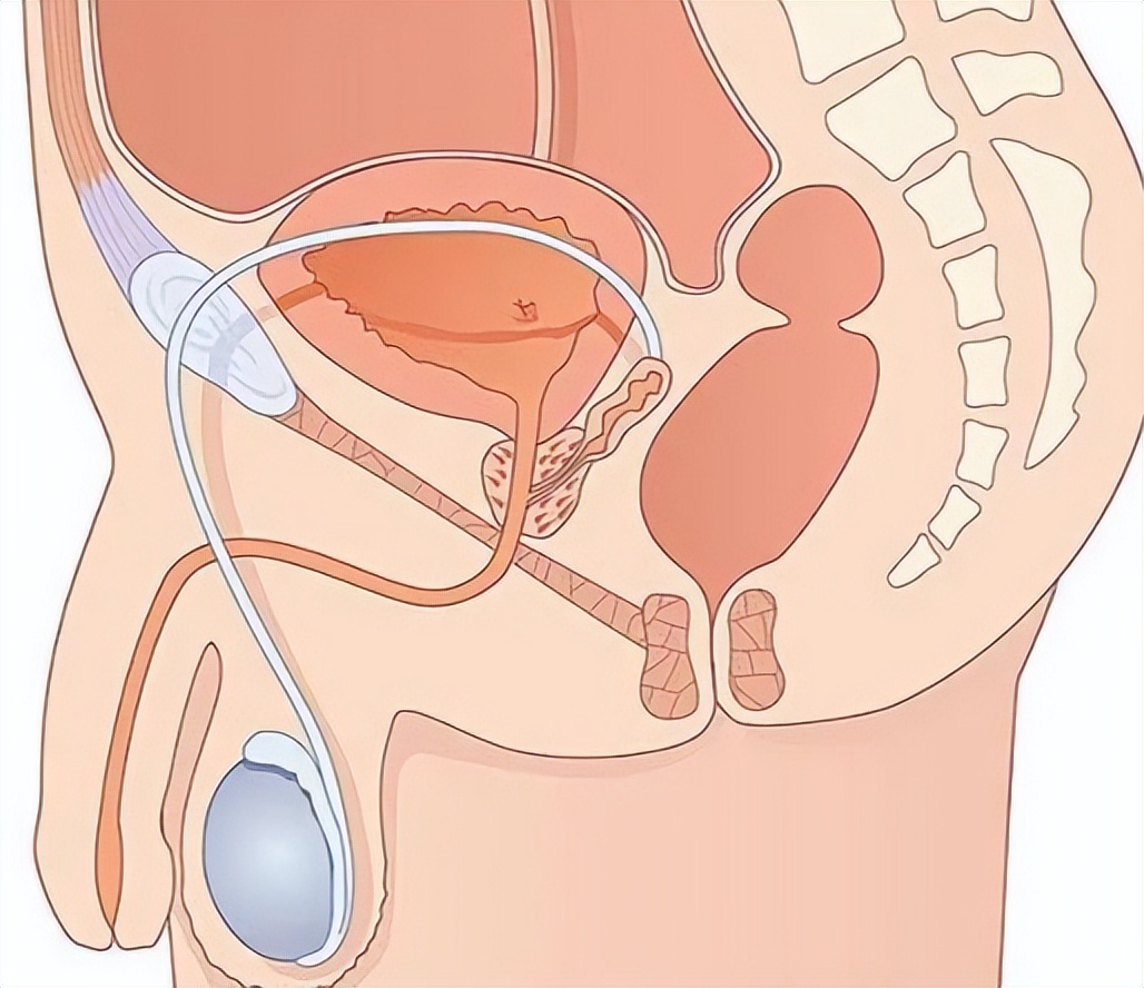 肝硬化病人水肿怎么回事,杨医生讲早期肝硬化的症状