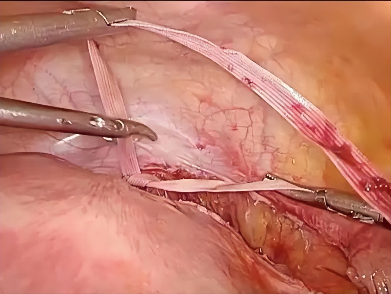 国内首例！顺义妇儿医院完成孕中期腹腔镜下宫颈环扎术