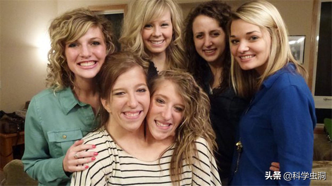 连体姐妹其中一个人死了怎么办,连体姐妹一个死了另一个咋办