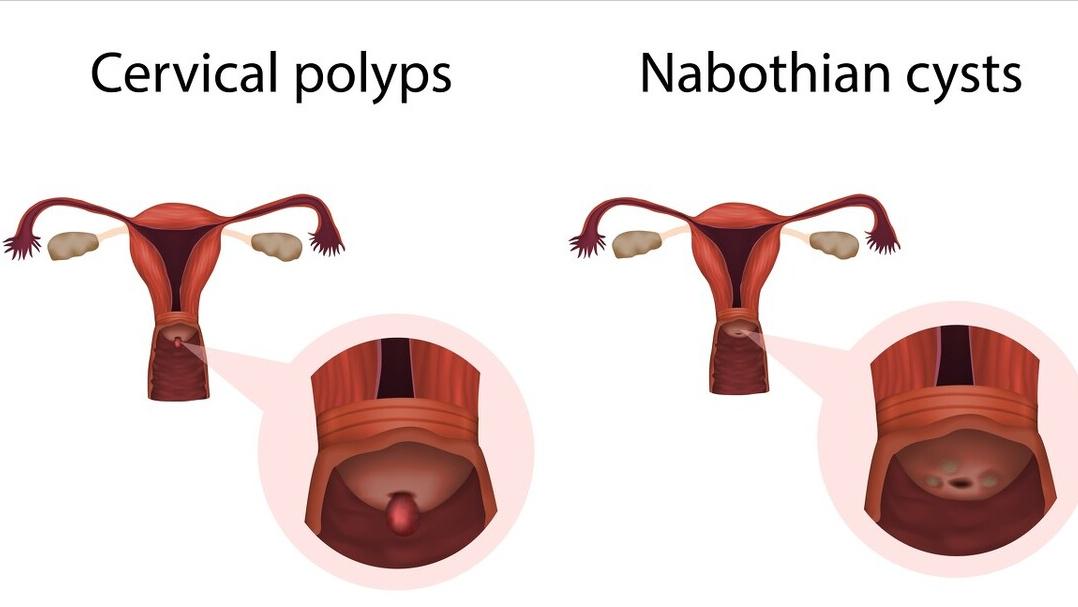 子宫内膜偏厚中医怎么治,绝经子宫内膜厚癌变几率大吗