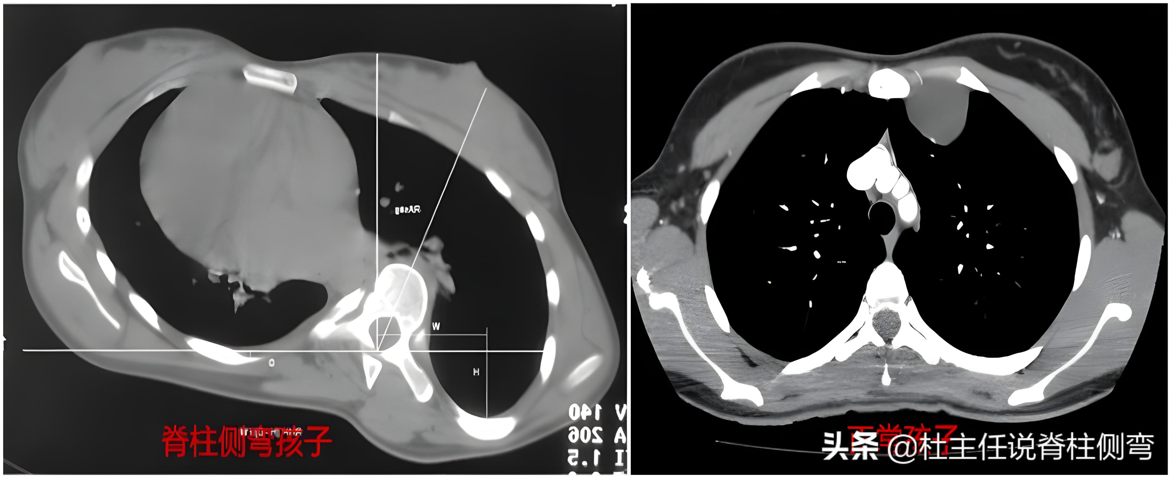 知识科普脊柱侧弯患者的康复锻炼,脊柱侧弯出现剃刀背必须手术吗