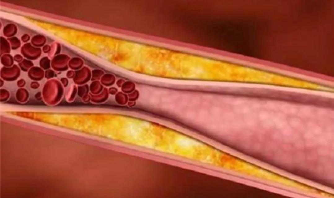 低密度脂蛋白胆固醇算高血脂症吗,高血脂的低密度脂蛋白控制在多少