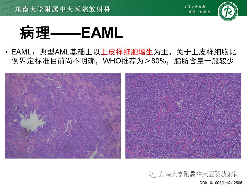 好文分享——《肾血管平滑肌脂肪瘤》
