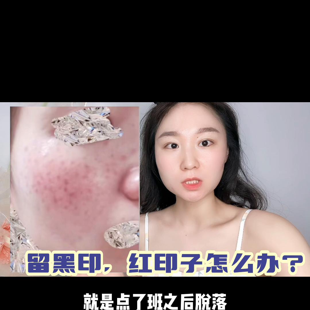 激光点痣掉痂后红印子可以护肤吗,点痣后的红印子可以正常护肤吗
