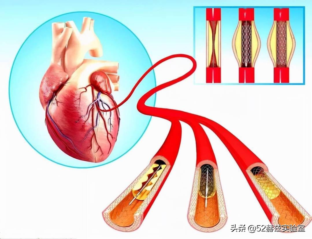 从13000元骤降至700元！看国产心脏支架如何吊打国外？
