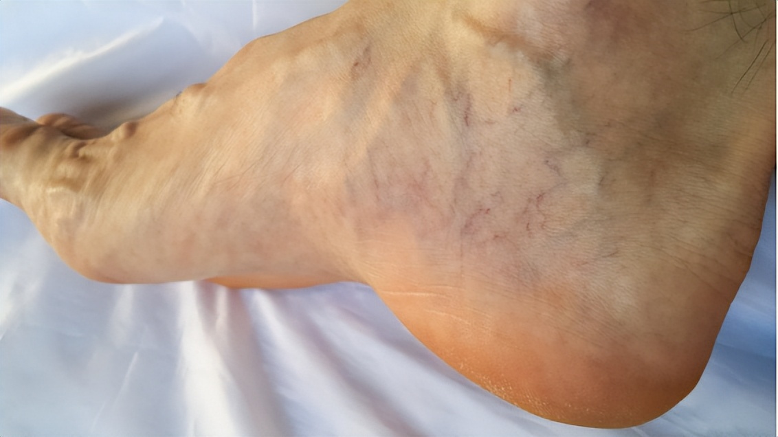 如果尿酸高一般有哪些症状,尿酸高的人若身体出现这3个变化