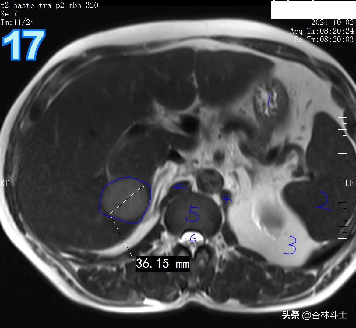 肝癌8公分肿瘤能活多久,肝癌细胞最大长多大