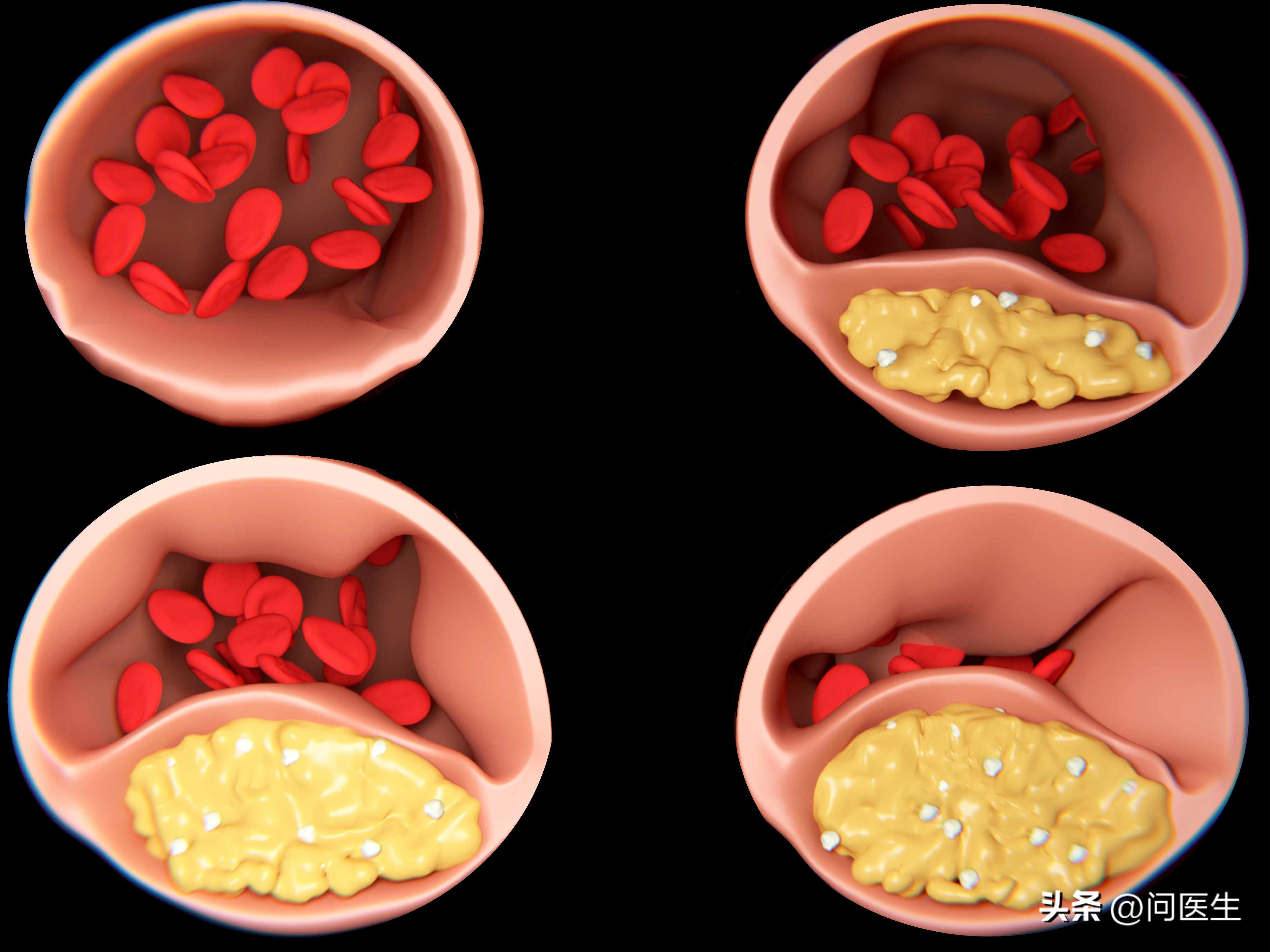 高血脂如何快速降血脂,年轻人血脂高怎么控制