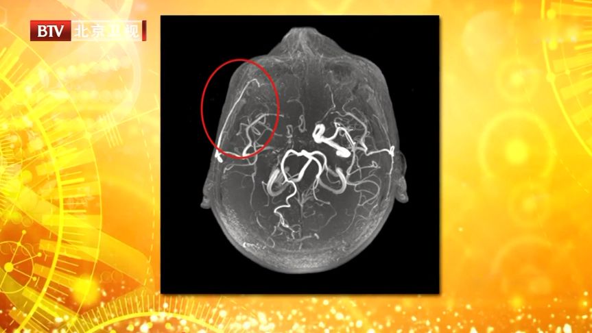 头痛的“元凶”终于找到了！痛在哪里，病因在哪儿？一文都告知你