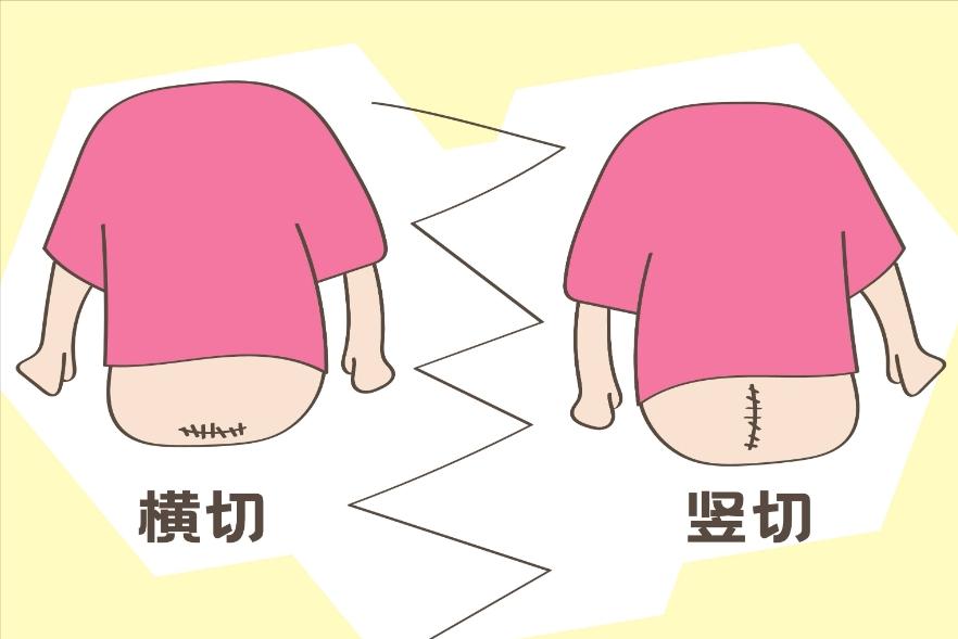 剖腹产后多长时间可以同房？过早*生活性**有什么风险？进来告诉你