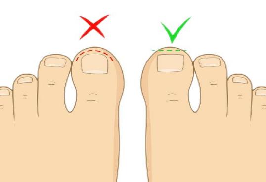 甲沟炎带来的足部疼痛,得了甲沟炎为什么脚趾痛