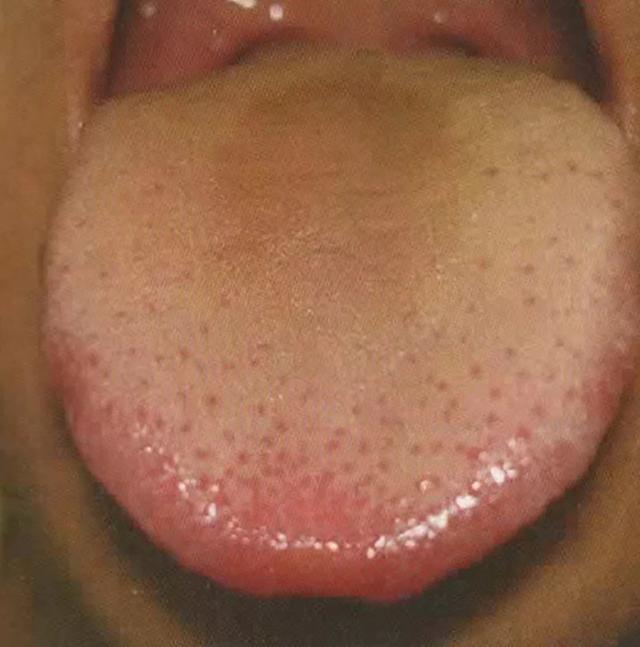 大便湿粘不成形怎样治疗,大便粘湿不成形何原因