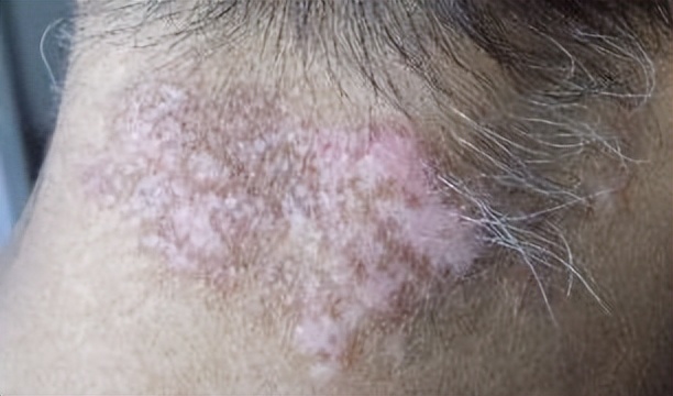 汗毛变白是不是已经变成白癜风了,毛囊型的白癜风会导致毛发变白么