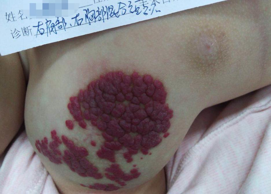 婴幼儿血管瘤有哪几种类型,婴幼儿血管瘤治疗后会留疤吗