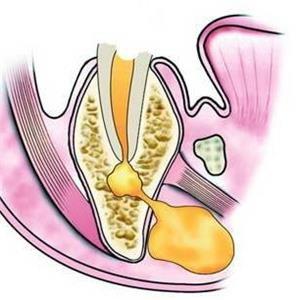 口腔牙龈内壁长硬包是上火吗,牙龈肿痛上火有个脓包怎么办