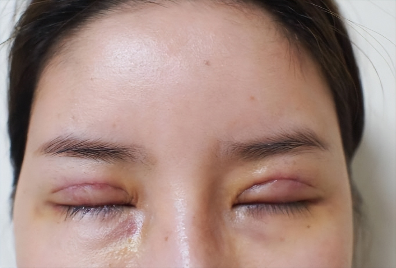 双眼皮做什么术式的好,微创双眼皮术式