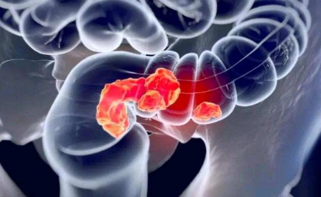 结肠息肉严重吗,结肠息肉癌变了严重吗