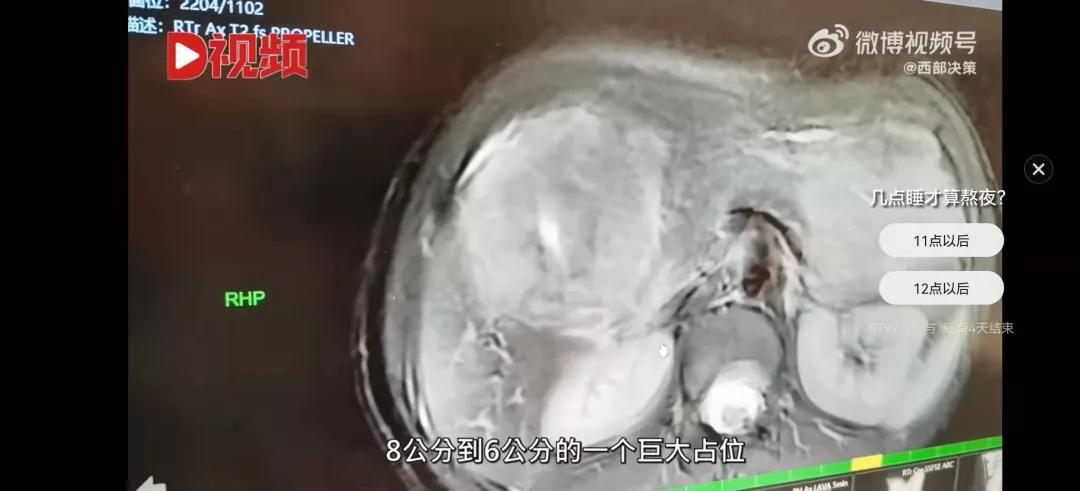 长期熬夜切掉半个肝,熬夜吃烧烤切掉半个肝