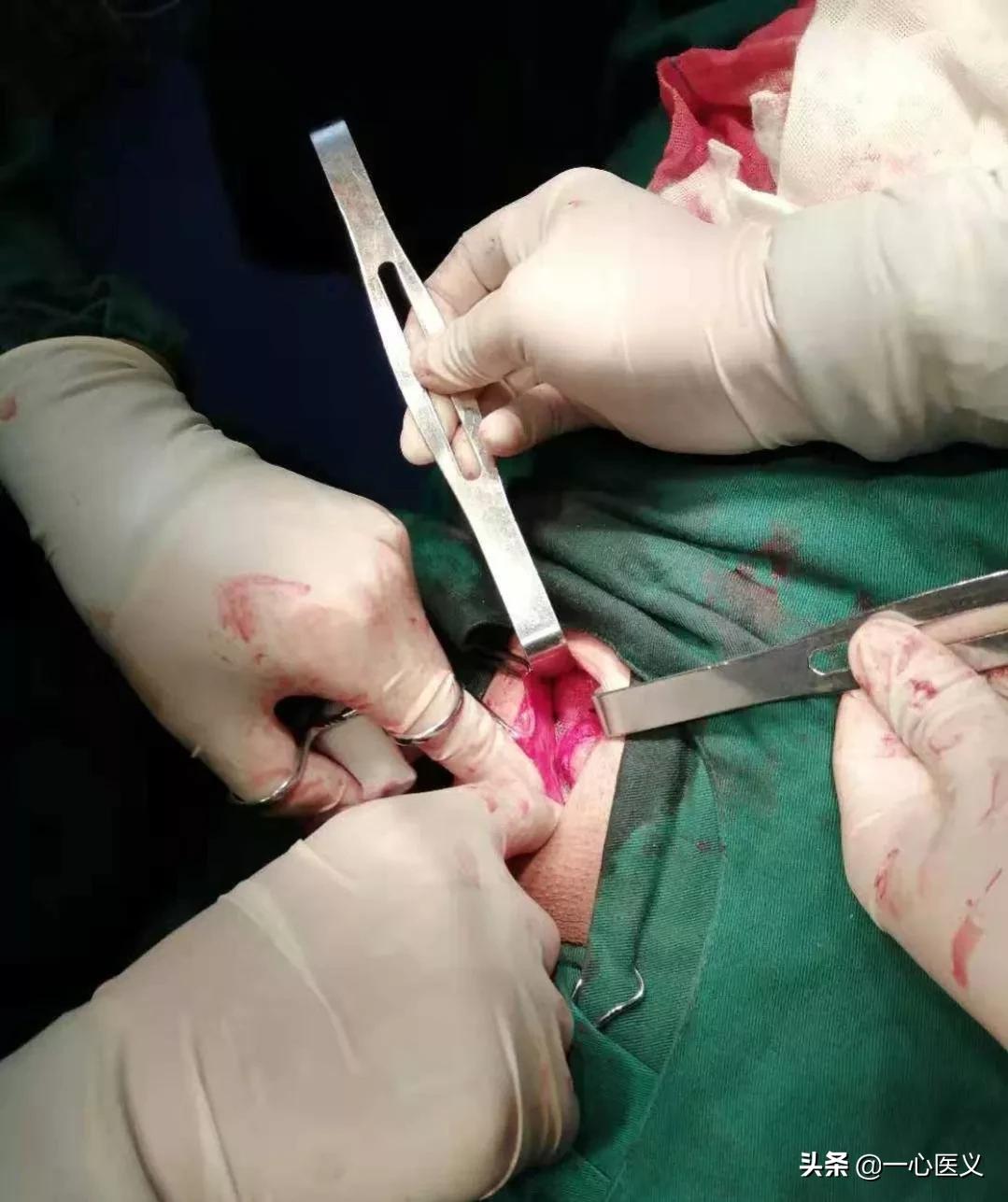 无张力疝气修补后一辈子不复发吗,腹股沟疝气无张力修补术会复发吗