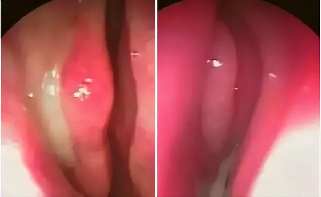10秒治鼻炎,鼻炎5秒通鼻最快的方法