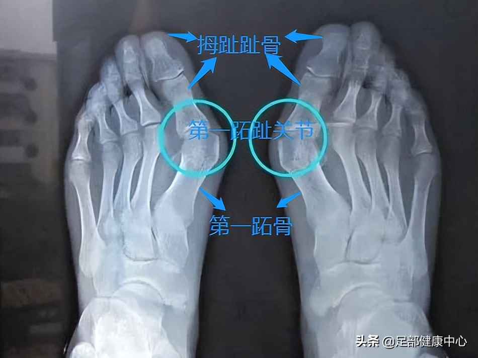 拇趾又歪又肿痛！这个女性高发病你得要小心