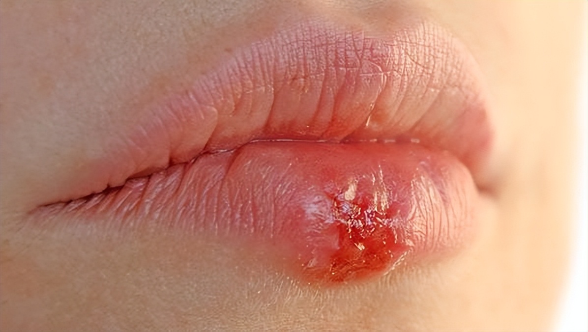 烂嘴角是怎么回事是上火吗,烂嘴角到底是什么病