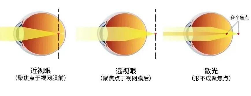 南阳市南石眼科医院,南阳南石眼科能治斜视吗