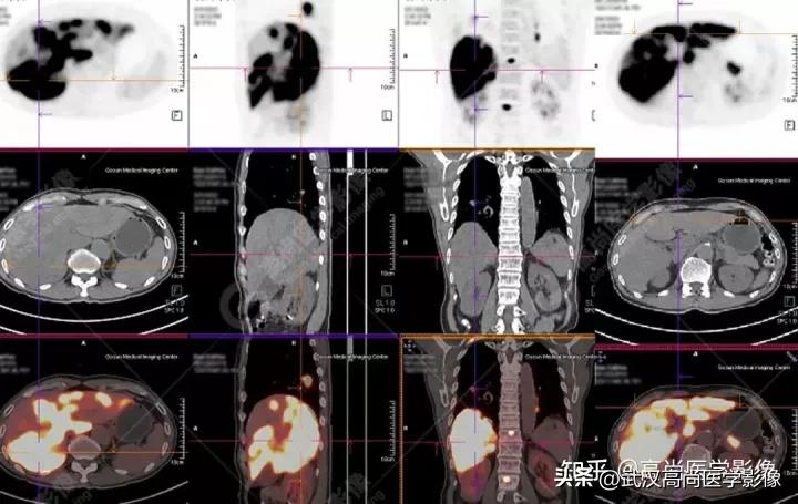 10毫米的肺结节恶性死亡率有多大,1厘米多的肺结节良性可能性多大