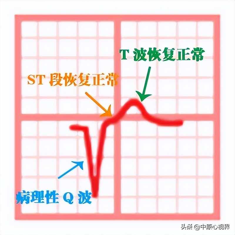 护考几种常见的心电图,常见的心电图图形分析