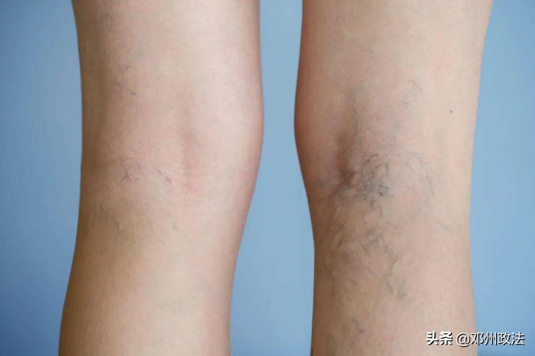 下巴青筋所暗示的疾病信号,身体的各部位青筋暴起是怎么回事