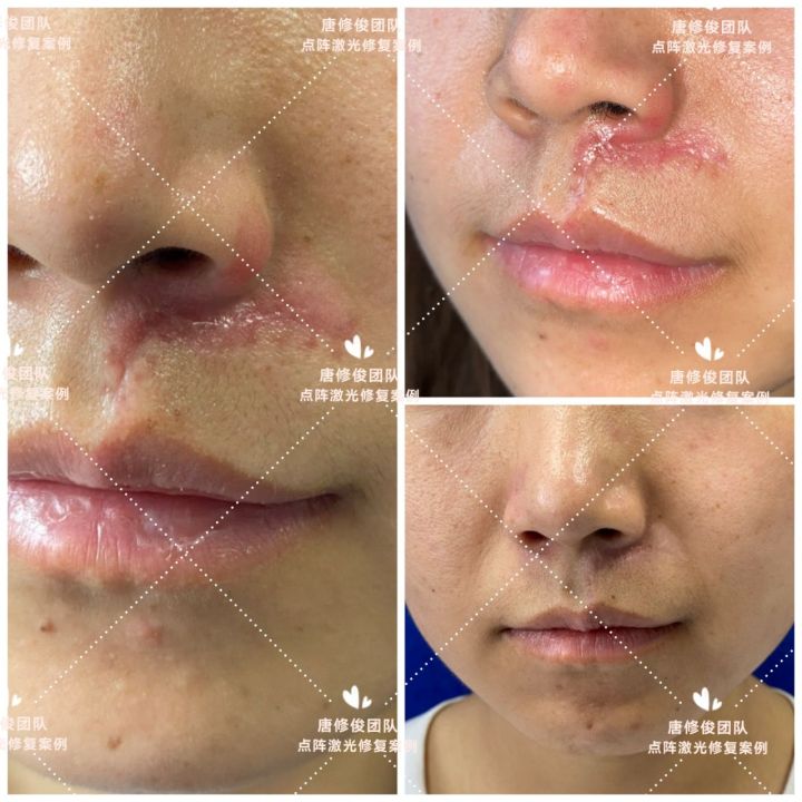 点阵激光后的伤口要几天愈合,点阵激光对去除疤痕效果明显吗