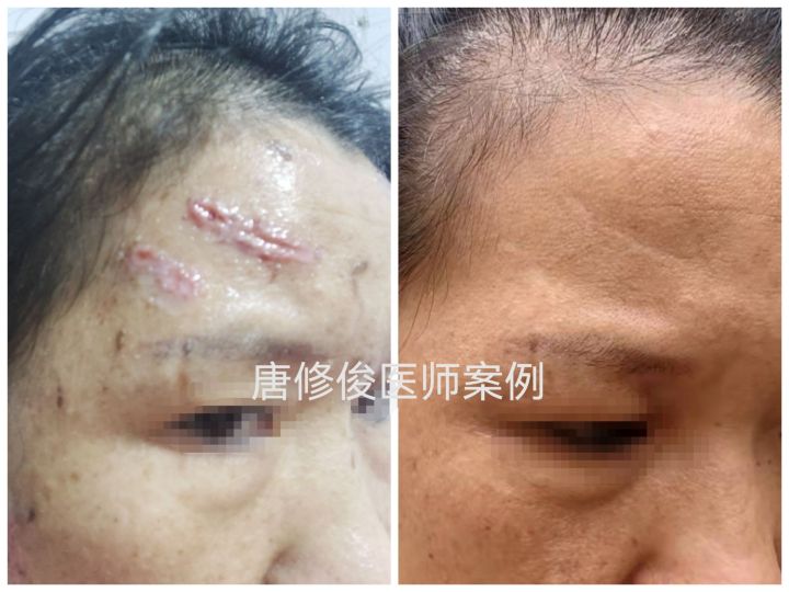 疤痕早期激光干预,疤痕激光治疗最佳方法