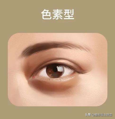 黑眼圈是不是要早点睡就可以改善,每天几点睡才可以淡化黑眼圈