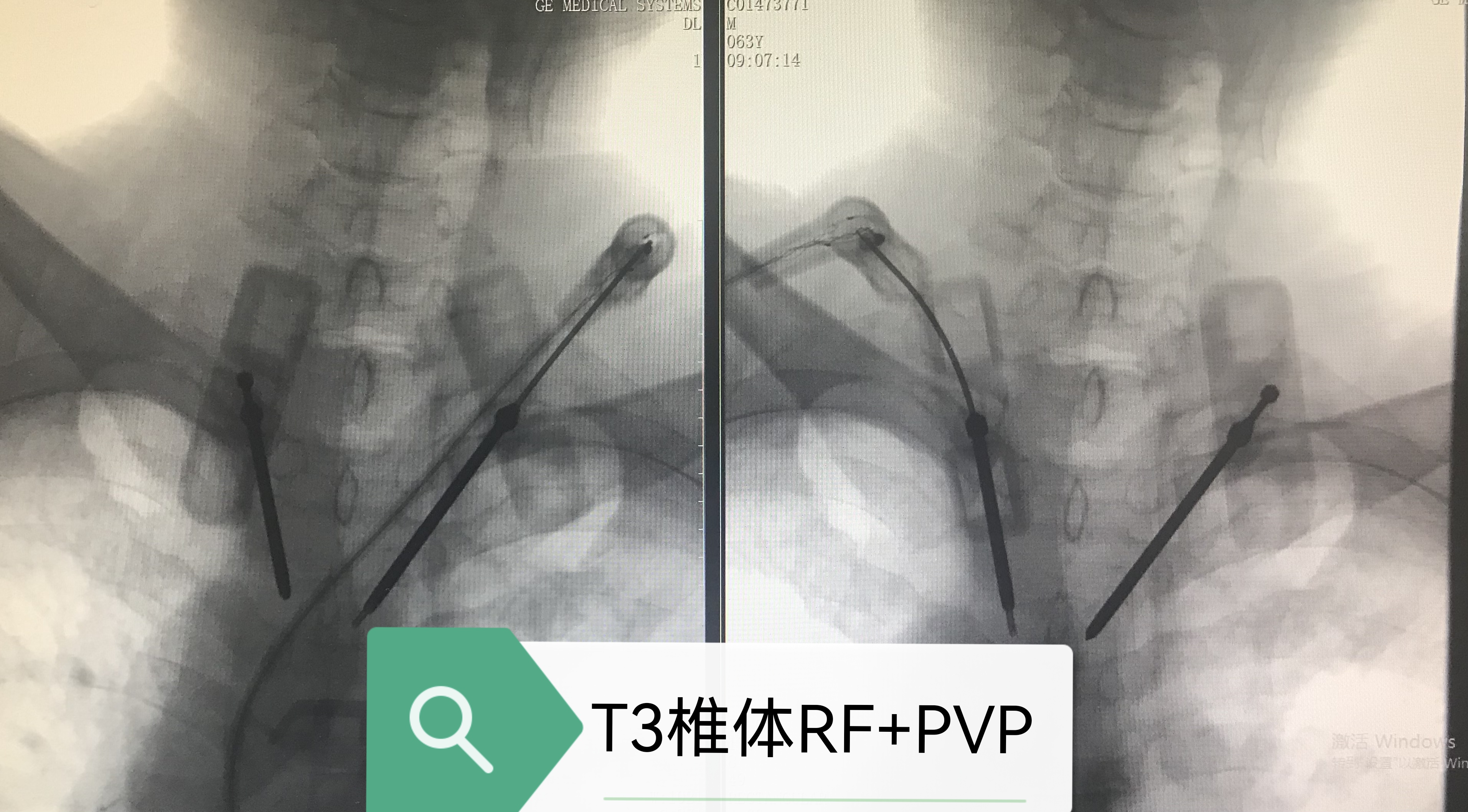 病例Ⅴ：RF+PVP联合治疗高位胸椎溶骨性转移瘤及压缩骨折