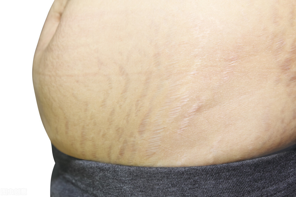 孕期长妊娠纹怎么消除,孕期长妊娠纹怎么办补救