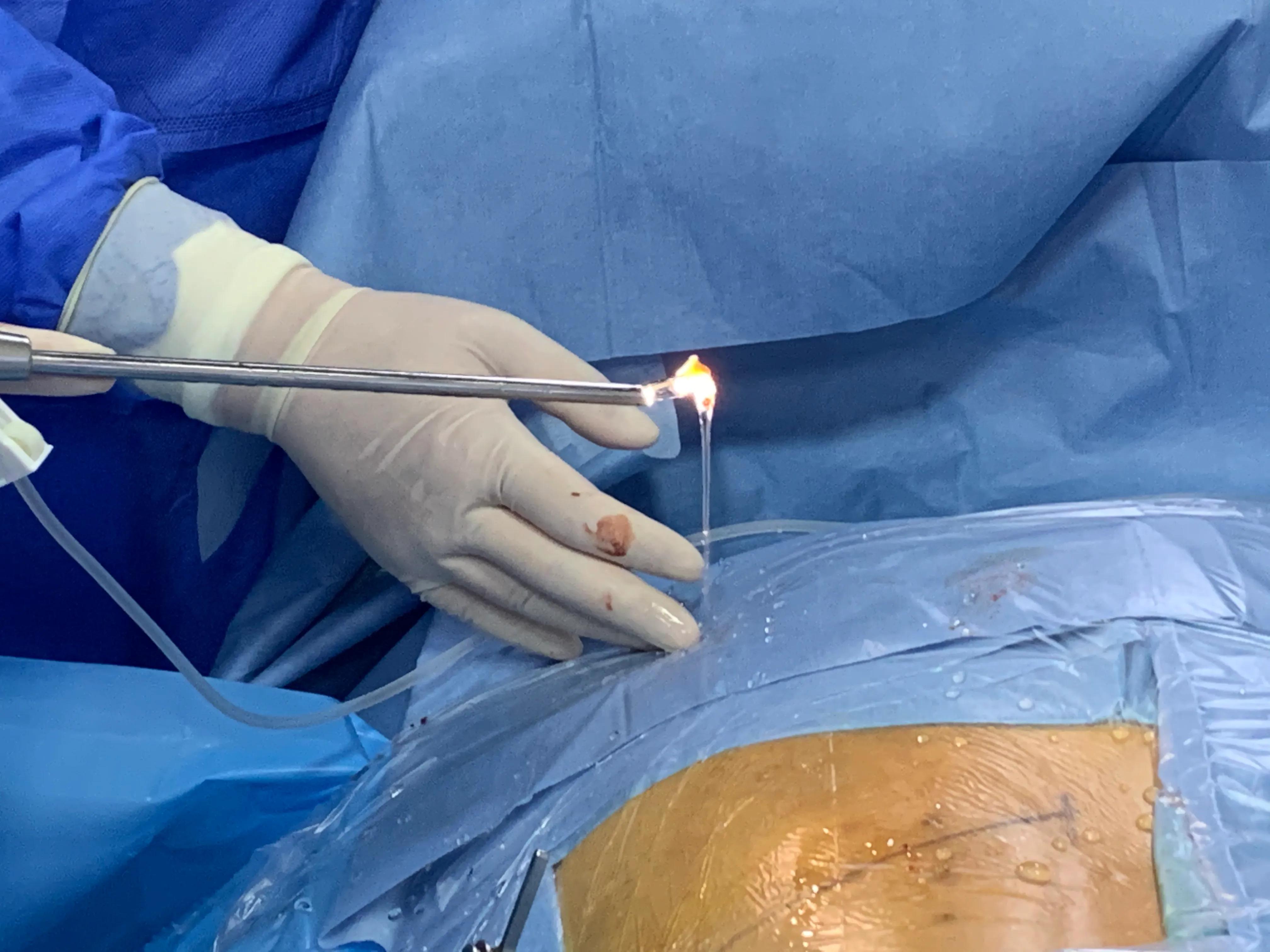 腰椎间盘突出345s1可以微创吗,腰椎间盘突出微创手术后康复动作