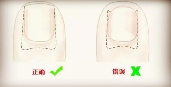 脚趾甲总往肉里扎该怎么办,脚趾甲往肉里长又疼又痒教你一招