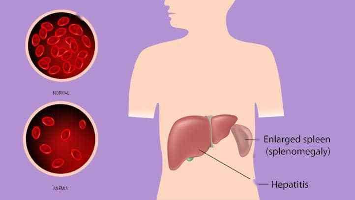 体检中查出胆红素偏高怎么办,体检胆红素增高怎么解决