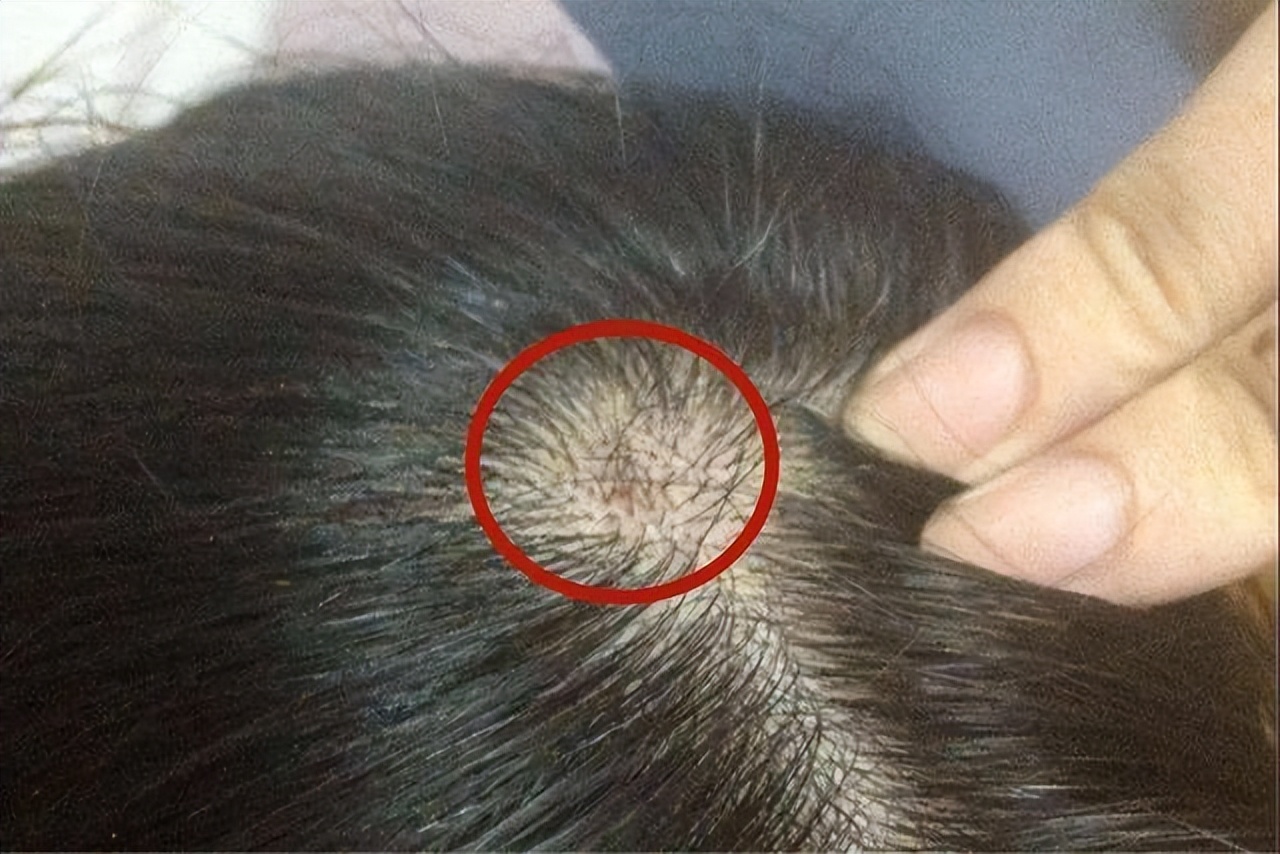 为什么头皮上老是长脓包和疙瘩？医生说出原因和改善方法