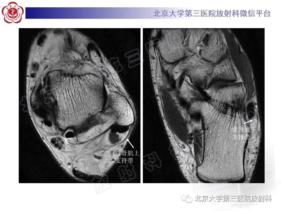 好文分享续集,腓骨肌腱脱位手术价格