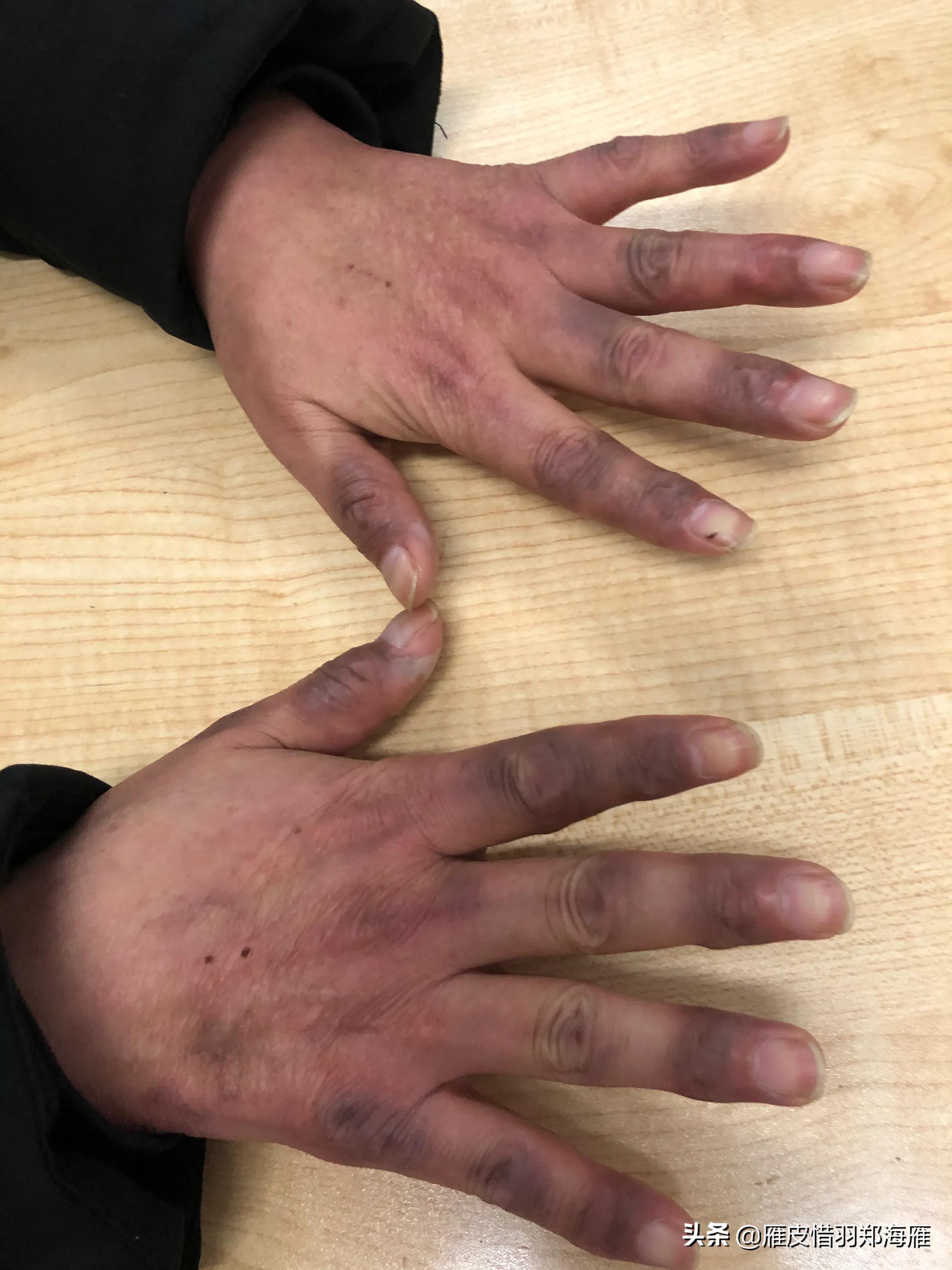 嘴周长红疹子是什么原因,无缘无故过敏起红点