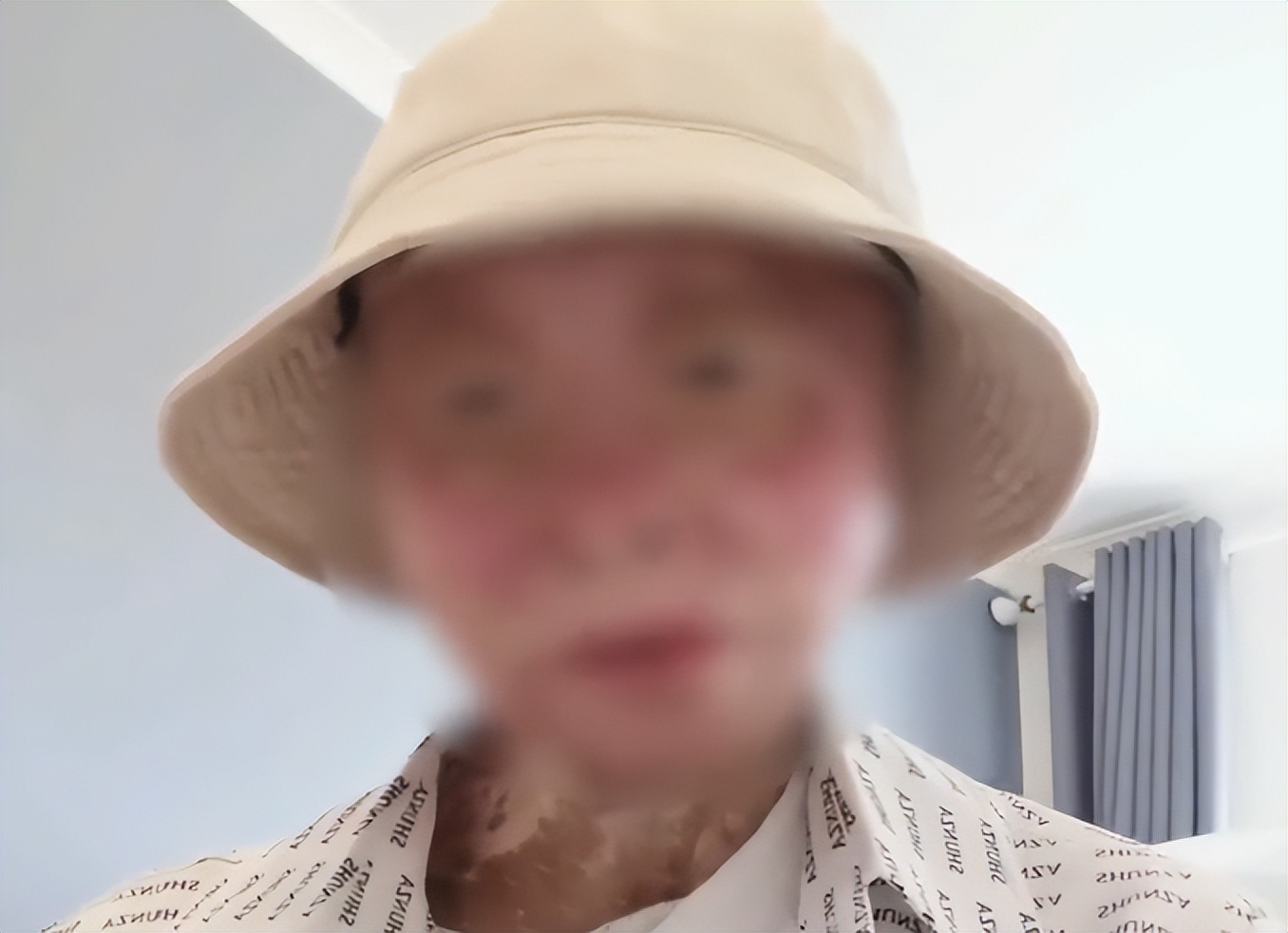 四川24岁女孩烧伤928天后重生，全脸毁容永失双手：不幸中的万幸