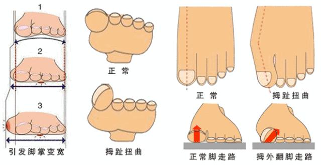 如何判断足弓过低,足弓塌陷对腿型影响