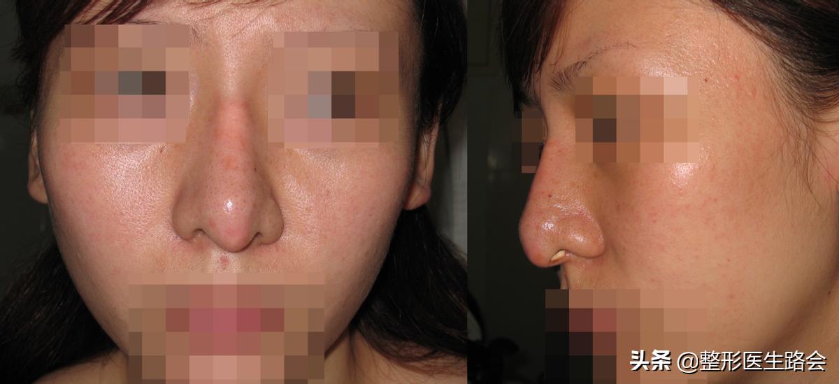 为什么隆鼻很久了鼻子还会歪,隆鼻了怎么确定鼻型歪不歪