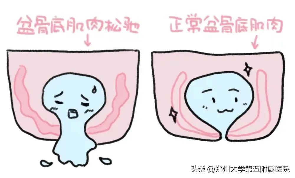 剖宫产盆底肌修复有必要做吗,剖宫产后恢复盆底肌腹直肌