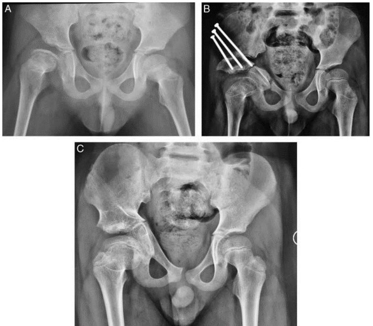 北京积水潭医院脊柱微创视频,北京积水潭医院矫形骨外科