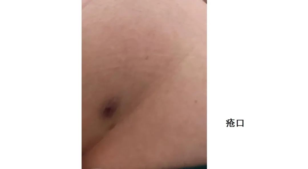 女子去抽脂手术后脸上溃烂,厦门华美整形医院抽脂