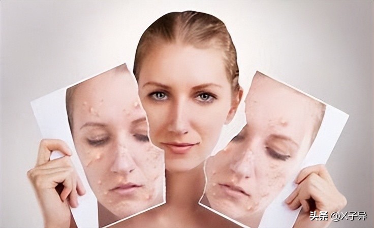脸上长痘怎么办最快的方法,12岁女孩脸上长痘怎么消除